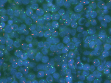 Descifrando la heterogeneidad de los linfomas de células B difusos